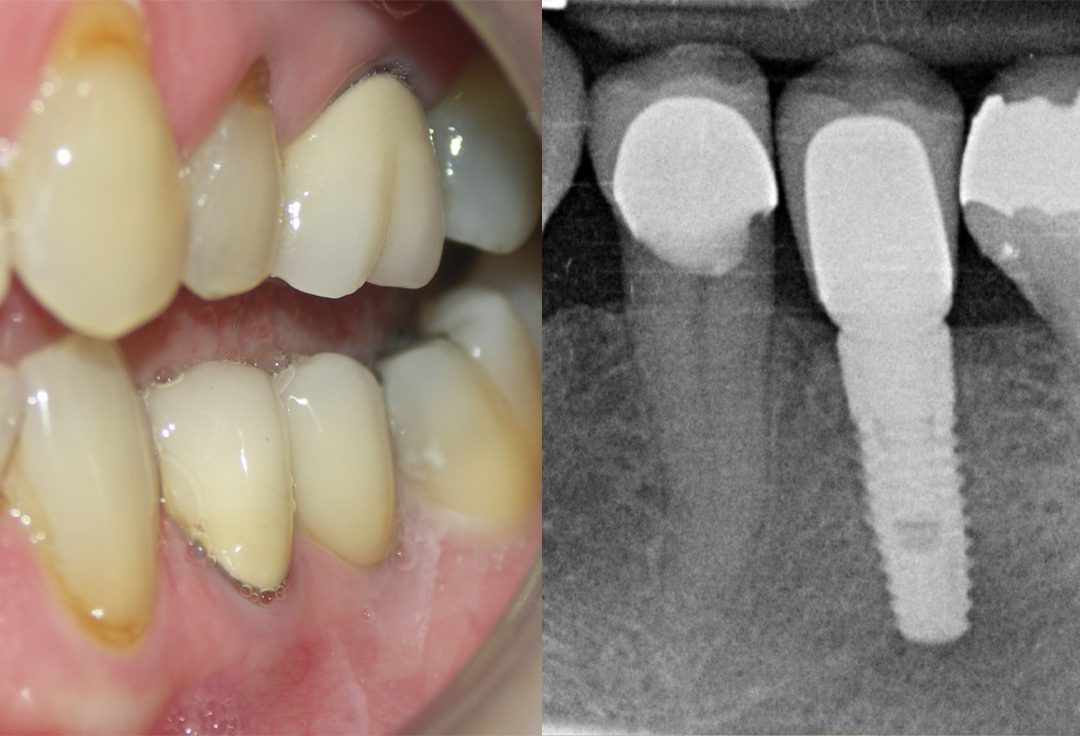 Implant Case - After
