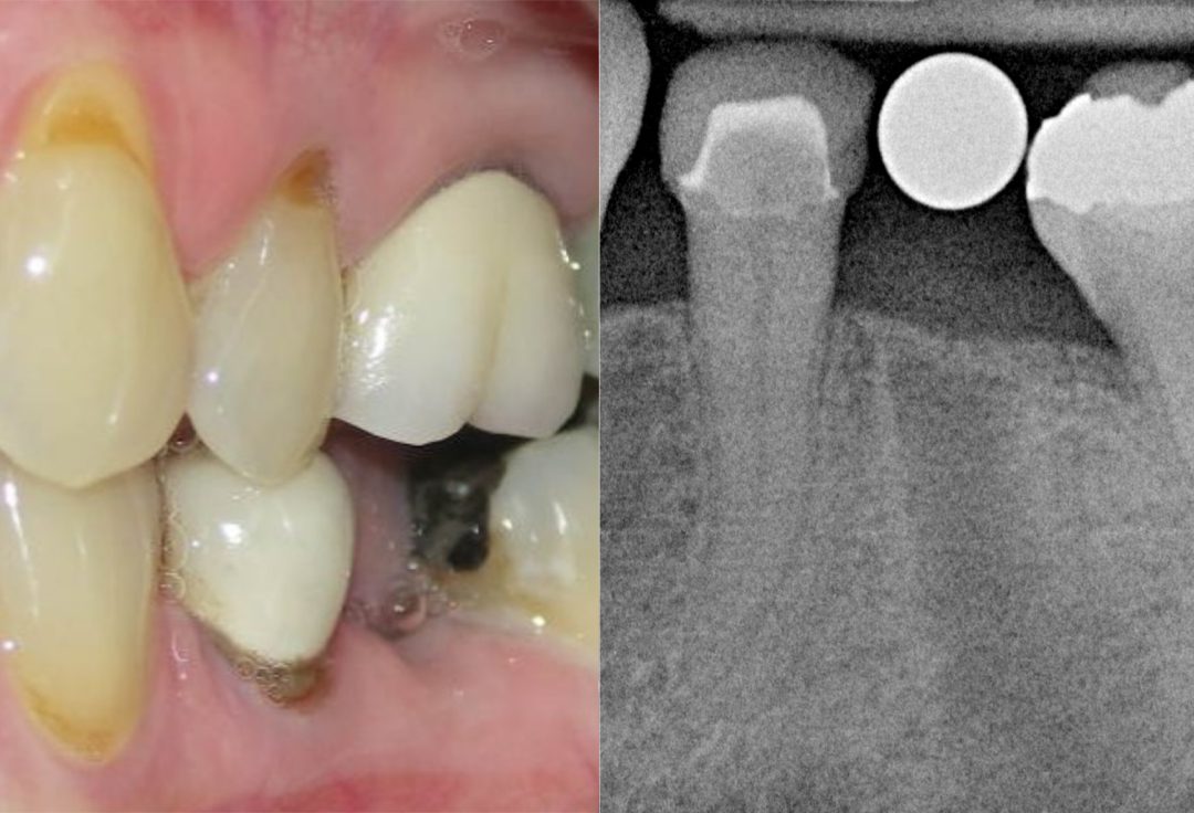 Implant Case - Before