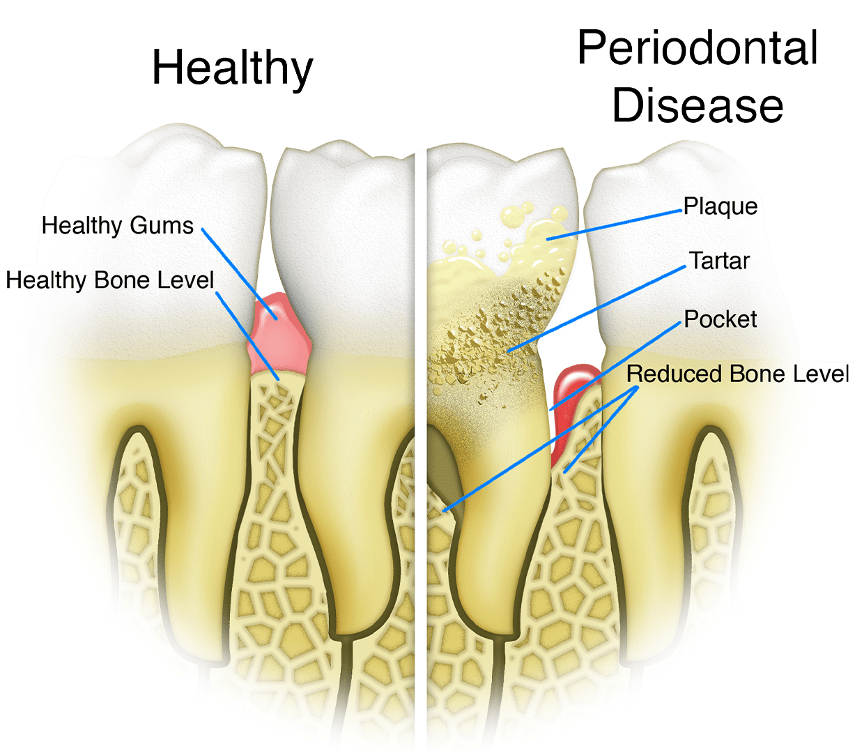 Periodontal Disease Detail Textbook Illustration